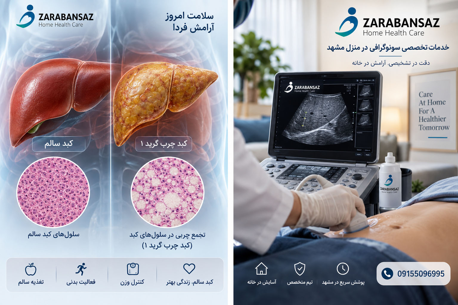 diagnosis-and-treatment-of-fatty-liver-grade-one (1)