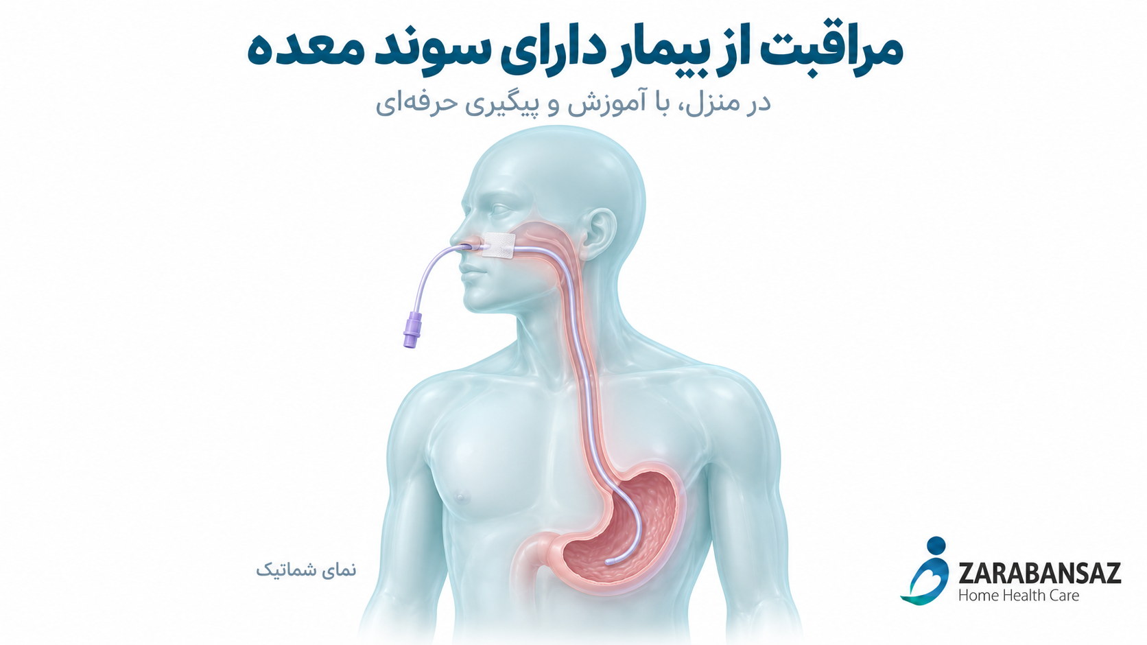 nasogastric-tube-feeding-home