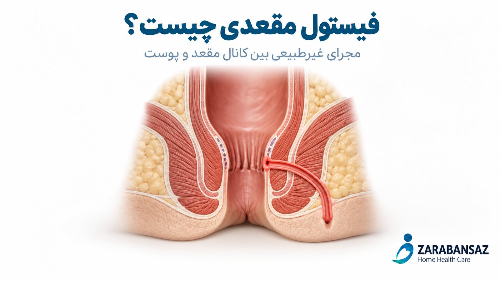 فیستول مقعدی