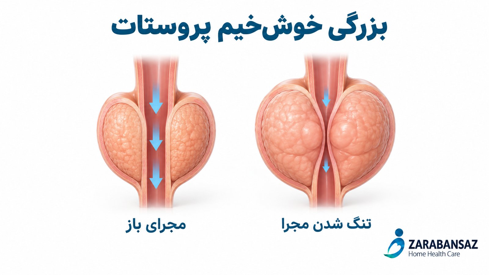بزرگی خوش خیم پروستات